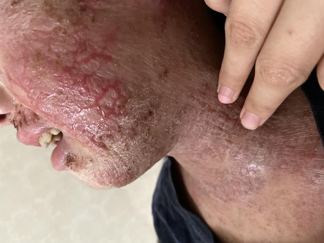 十年湿疹,特应性皮炎.