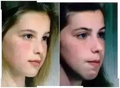 腺样体面容(右)