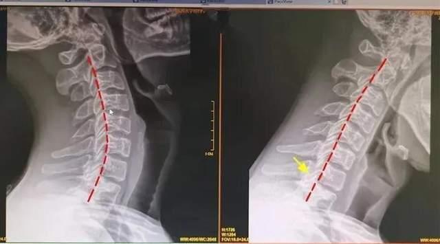 26岁程序员颈椎变形,严重到恶心呕吐,只因这个坏习惯