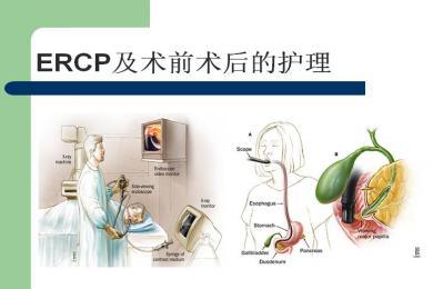 ercp术后护理ppt