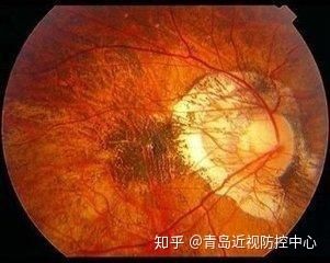 正常健康的眼底图像(透亮,干净)