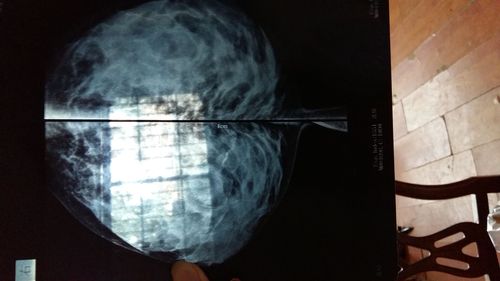 乳腺皮肤均匀,乳头正常,乳腺大导管相对正常,乳腺纹理不均匀,无肿块