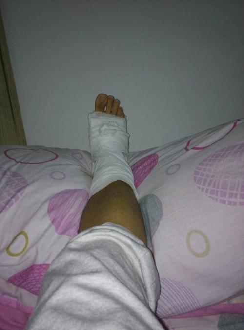 右脚踝外踝骨折,现已打石膏一个星期了,怎么脚底会发热但是手抚摸脚底