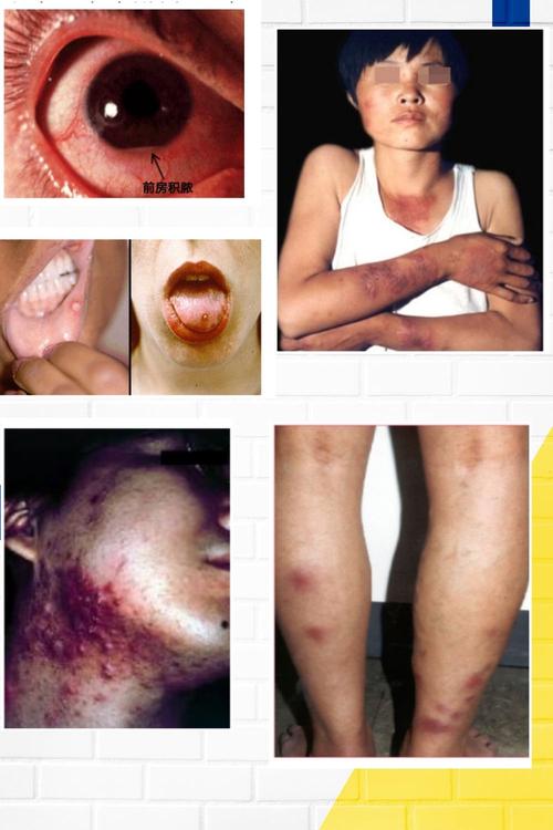 "重视反复口腔溃疡,皮肤破溃,认识白塞病"山西大医院风湿性疾病健康