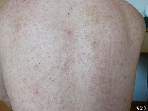 【请教】糠秕孢子菌 毛周角化 吗?