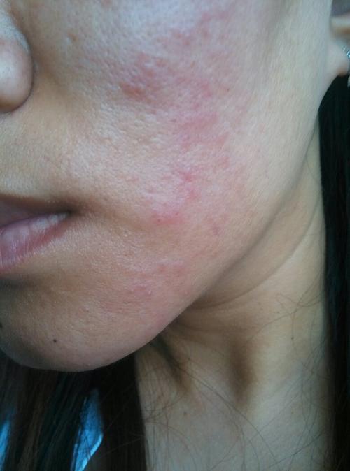 脸上发红,起红疹,有小白水泡,医院说过敏性皮炎治疗了