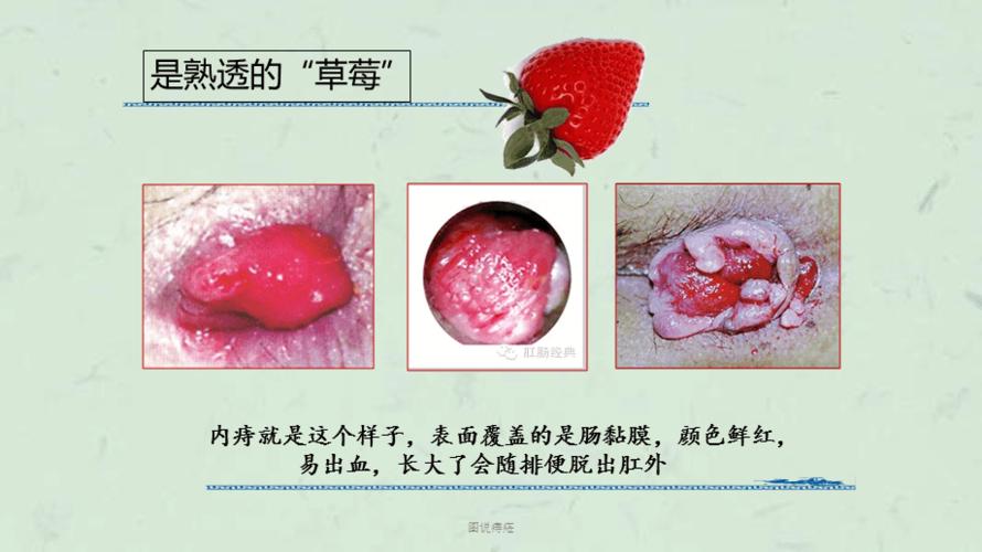图说痔疮课件