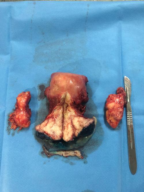 宫颈癌是可以早期发现的