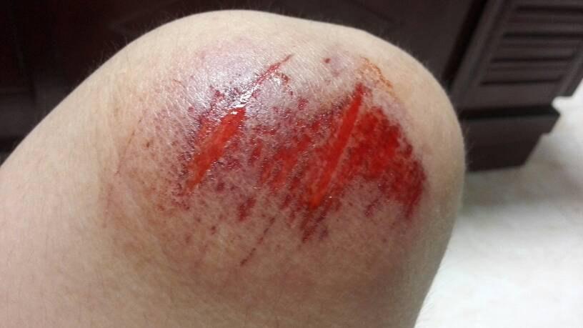 女孩膝盖摔伤真实图片 (第1页) 816x459   73kb   jpeg