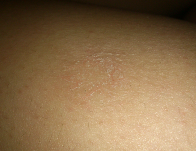 脸上经常起皮,像癣一样一块一块的怎么回事?