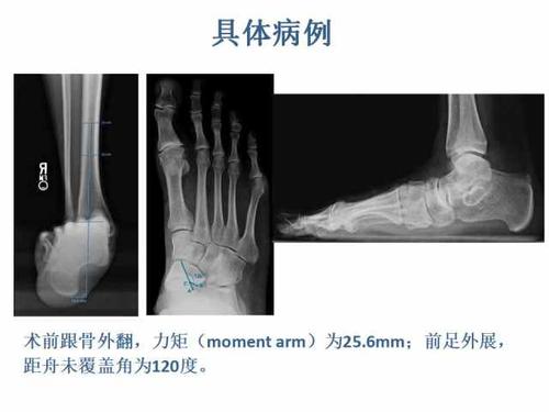 iib 期平足症在手术治疗中跟骨内移截骨和外侧柱延长定量程度的文献