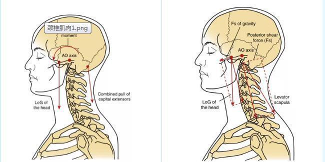颈部经常僵硬酸疼颈椎曲度异常怎么破