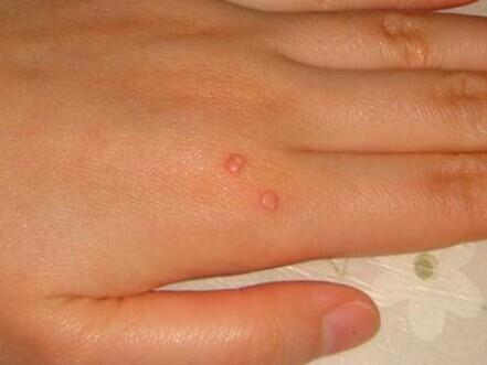 胳膊上长瘊子的图片