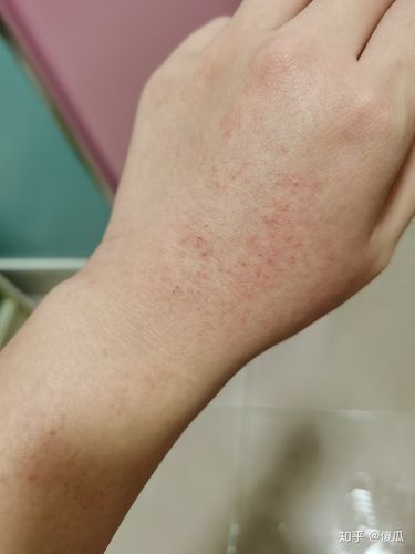 手背上有小红点突然