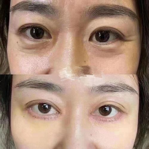 去眼袋后照片对比