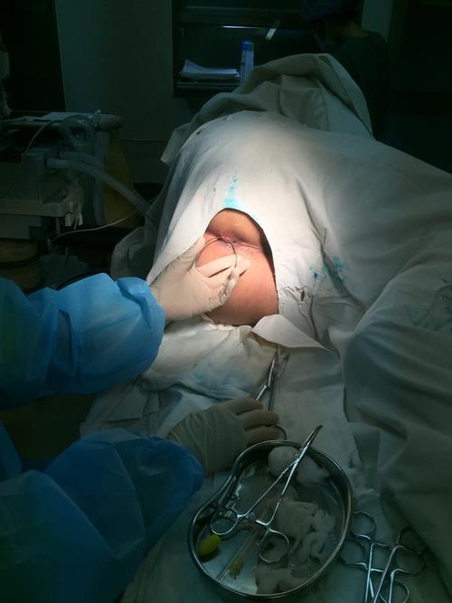 低位简单性肛瘘  位置低,单瘘管,内口明确,手术处理后恢复快.