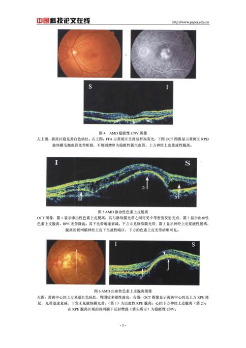 老年性黄斑变性中oct的图像解释.pdf