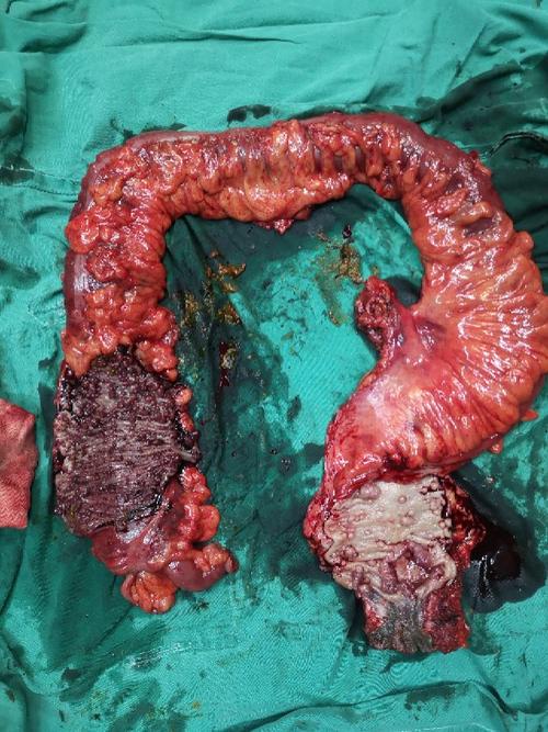 术后剖开标本,直肠二处癌变,升结肠布满息肉,很恐怖吧.