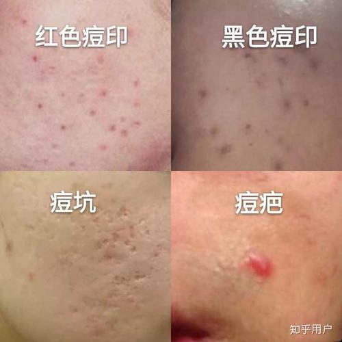 主要就分为 红色痘印,黑色痘印,痘坑,痘疤4种.
