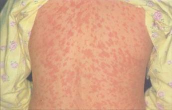 艾滋病有什么症状艾滋病皮疹的特征_皮疹一般特点_病