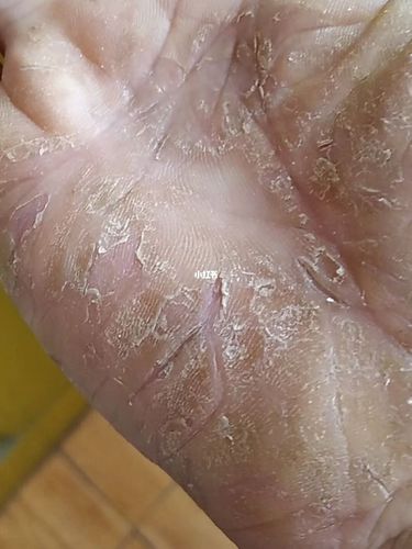 角化症湿疹伴皲裂～看效果_湿疹_医疗健康_医疗健康