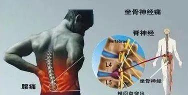 腰椎间盘突出的根不在于骨头而在于筋千万别给医生切啦