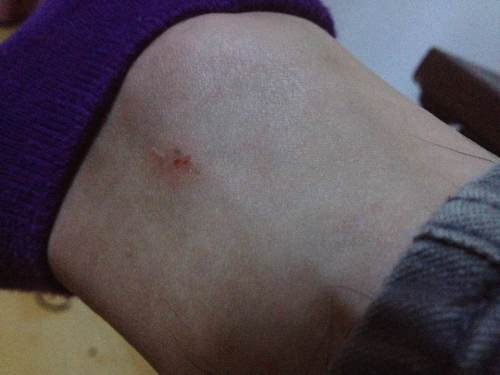 这是被蛇咬伤的牙印么 伤口没有出血 就是有两个红点 !