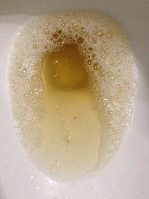 尿色异常:如果尿色呈浓茶色,洗肉水色,酱油色或浑浊如淘米水样时