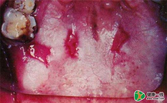 老年人口腔粘膜白斑不可小视