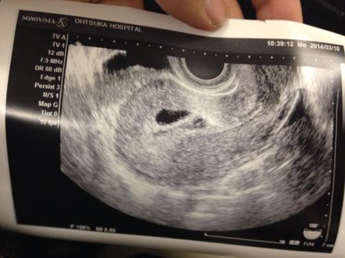 是双胞胎?这张图能看到胎芽了吗?   