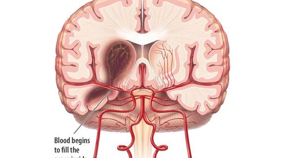 蛛网膜下腔出血并发血管痉挛的防治