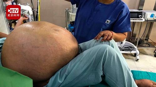 印度一女子腹中竟取出100斤肿瘤