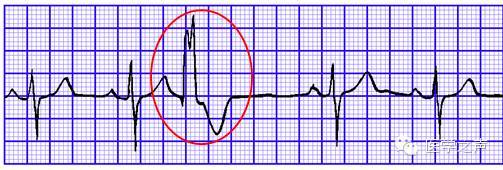 2,频发单源性室性早搏(呈二联律)