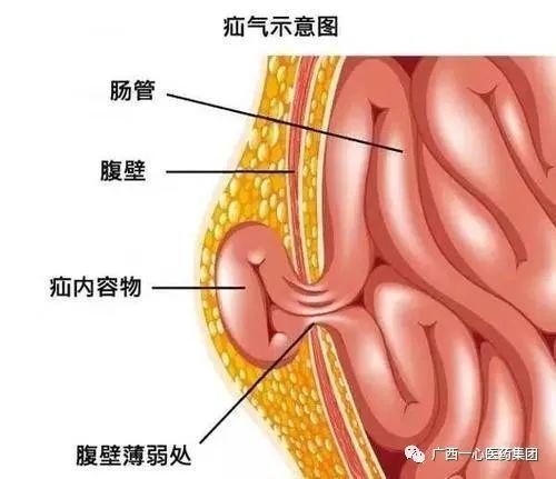 老年疝气老年人较为常见的疾病做子女的要了解啦