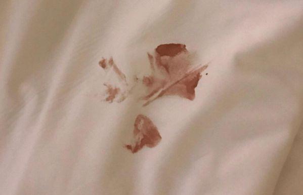 hpv出现到宫颈癌下身有2个信号若没有恭喜宫颈健康