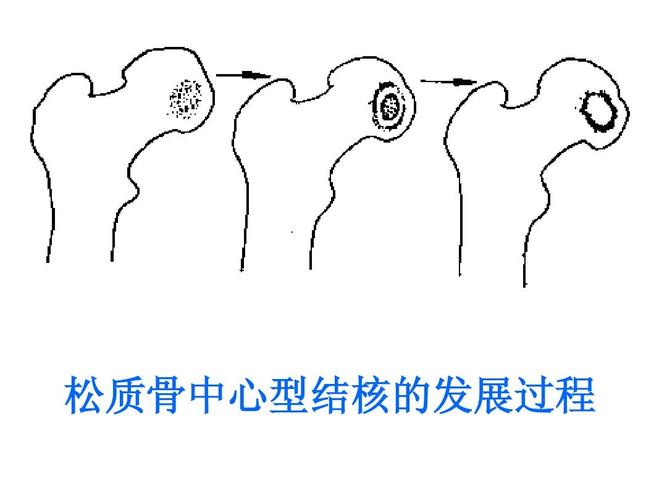 松质骨中心型结核的发展过程