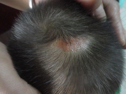 新生儿头上皮脂腺痣图图片_有来医生
