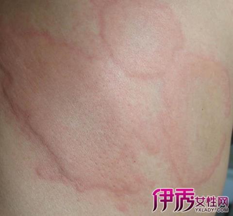 【图】血清性荨麻疹症状图片展示 其临床表现及治疗分析
