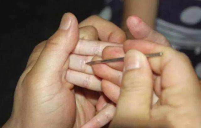 "挑疳(gān)积",是 用 三棱针(或其他钢针)选准手指的特定部位和穴位