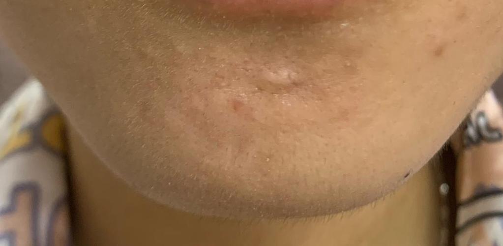 下巴疯狂长痘后留下痘疤