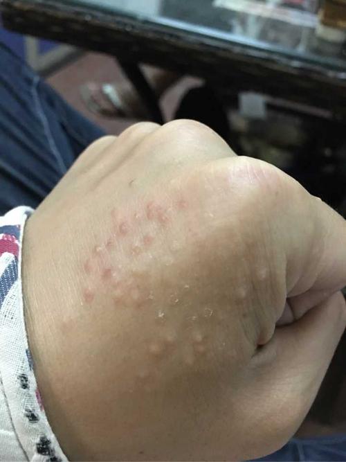 医生说接触性皮炎?