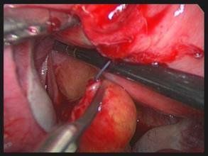 节育环的副作用有哪些 怎么使用节育环