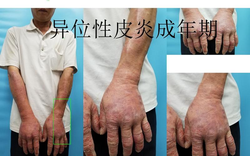 异位性皮炎(湿疹)的慢慢长征路