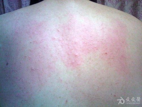 背上的红疹