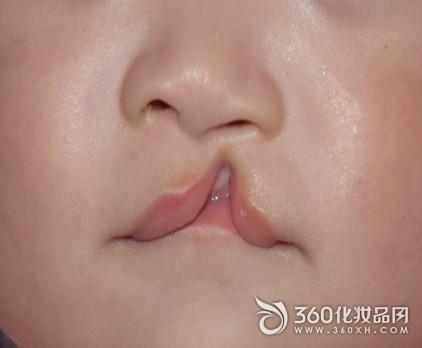 余文林什么是唇裂先天性兔唇能完全修复吗