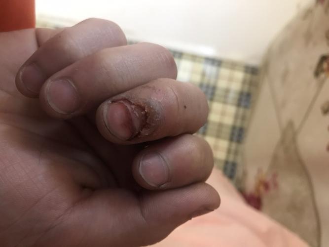 手指起疣好了之后还能跟以前一样吗
