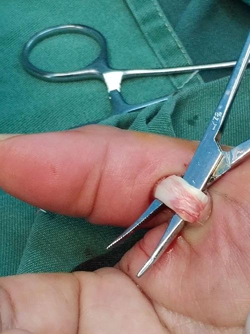 狭窄性腱鞘炎的手术治疗