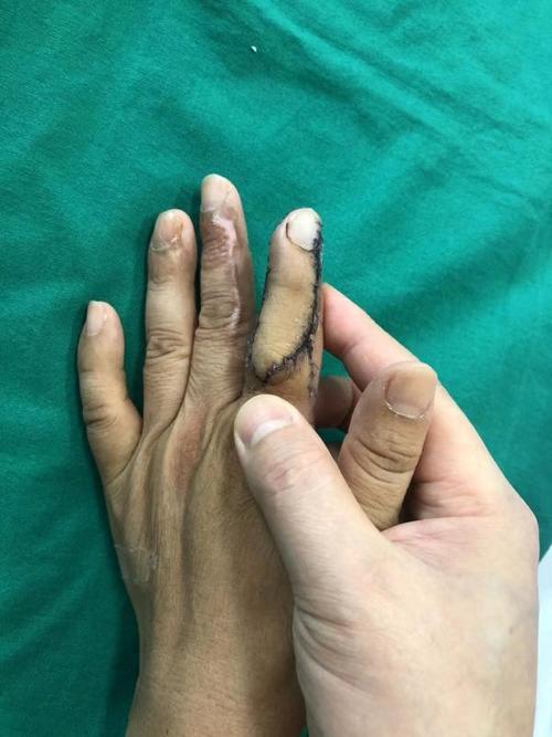 风险较大,能开展此类显微手术的医院较少,同时,有很多手指缺失的患者