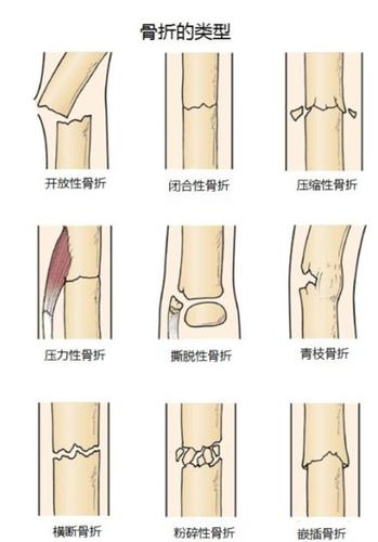 健康关于骨折的愈合与康复你知道多少呢