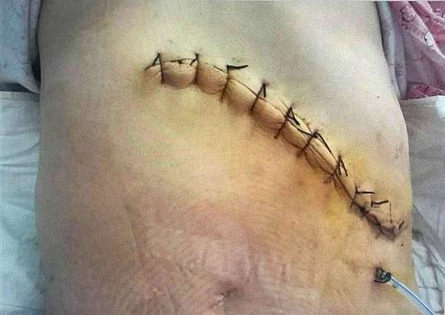 我院肝胆血管外科成功开展本院首例腹腔镜下脾切除术!